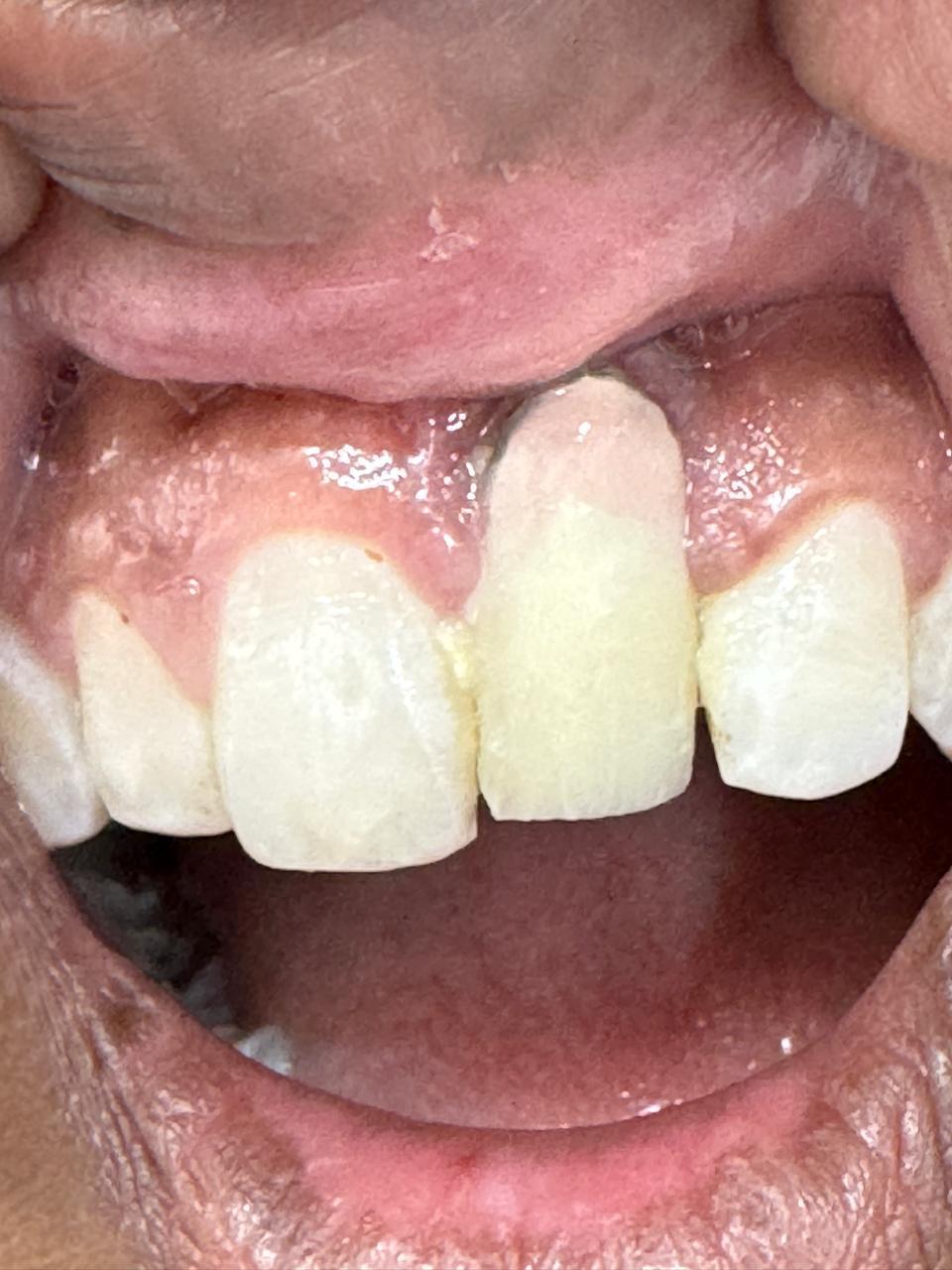 Improperly restored implant supported crown was redesigned before treatment